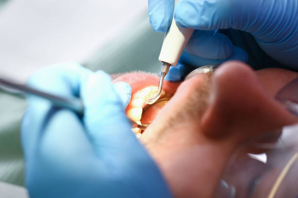 Best Emergency Tooth Extraction in Green Level, NC