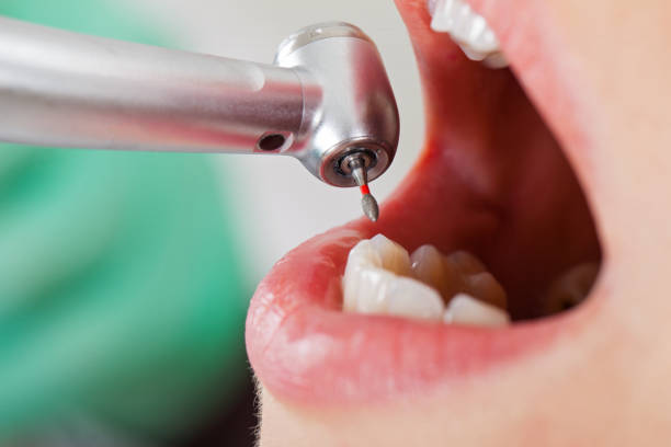 Best Emergency Root Canal Treatment in Green Level, NC